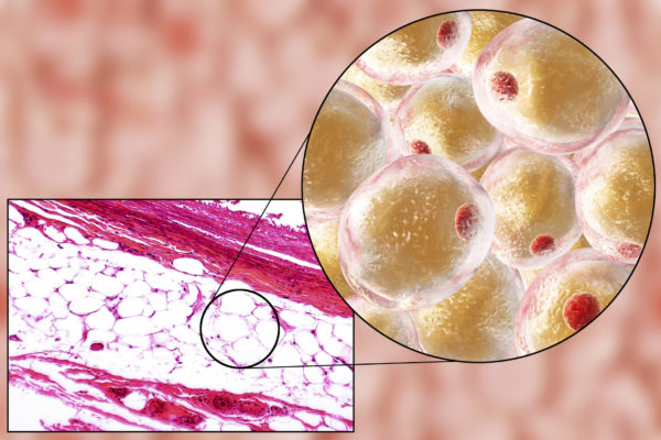 Localised Adiposity and Edematous Fibrosclerotic Panniculopathy (EFP)